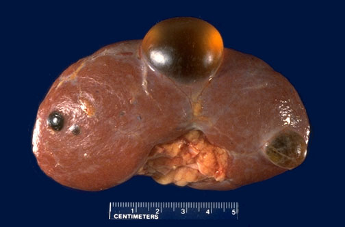 Laparoscoic Unroofing of renal cyst 